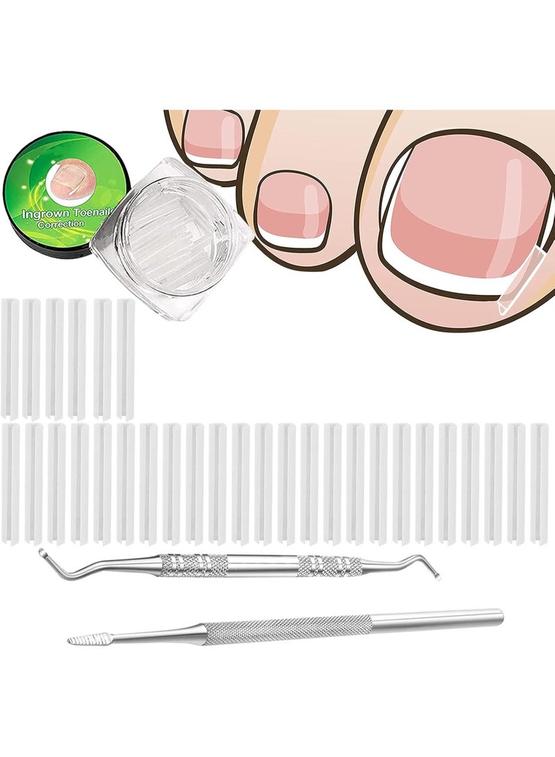 مجموعة تقويم الأسنان لأظافر القدم الداخلية ، بما في ذلك 30 بقعة تصحيح أظافر القدم الداخلية ، ومعدات حماية تصحيح أظافر القدم ، وأدوات إصلاح القدم ، ورفعات وملفات أظافر القدم الداخلية - Image 1